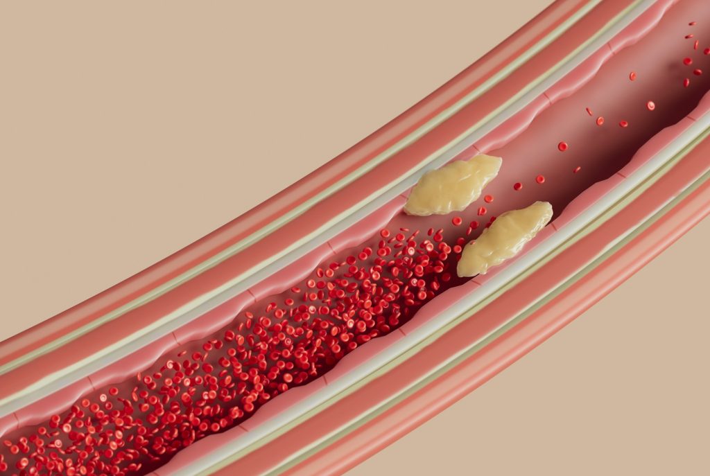 Medical illustration of a blood vessel with red blood cells and plaque buildup narrowing the artery.
